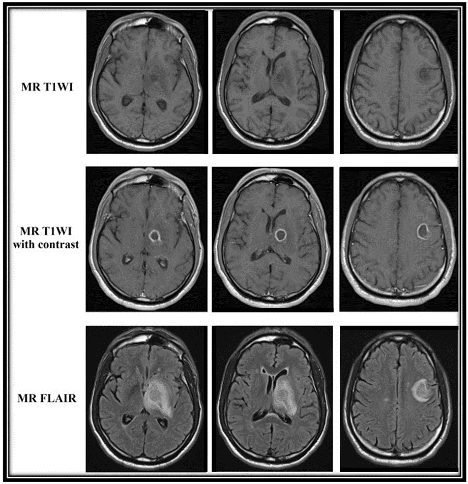 Acute Disseminated Encephalomyelitis | Pediatric Radiology Reference  Article | Pediatric Imaging | @pedsimaging